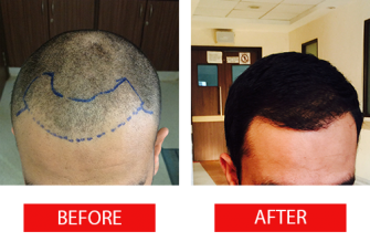 A Helpful Guide on Hair Transplant and Restoration