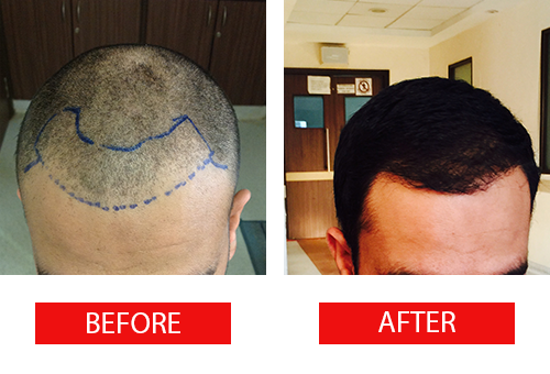 Best_Hair_transplantation